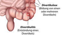Divertikulose