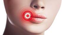 Lippenherpes